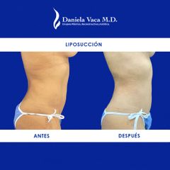 Liposucción - Dra. Daniela Stephania Vaca Grisales