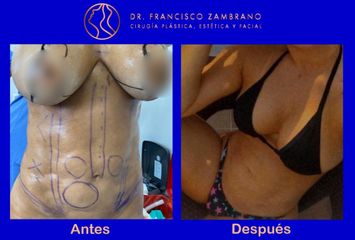 Dr. Francisco Zambrano - Eliminacion de fibrosis , pexia mamaria lipoinyeccion glutea
