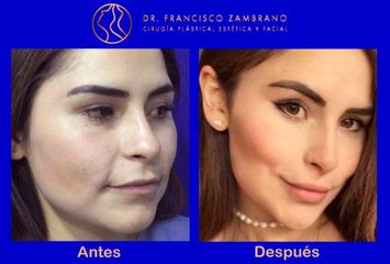 Dr. Francisco Zambrano - Rejuvenecimiento facial 