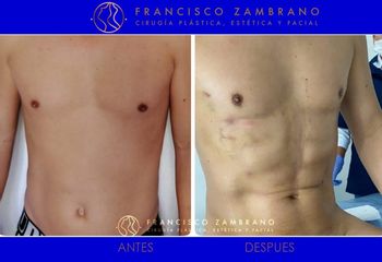 Dr. Francisco Zambrano - Liposuccion, lipoinyeccion glutea, marcacion abdominal