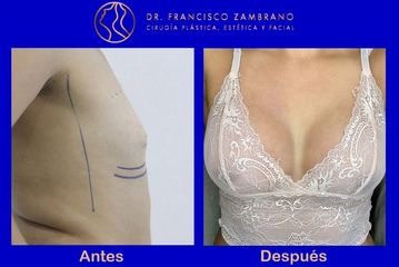 Dr. Francisco Zambrano - Mamoplastia de aumento 