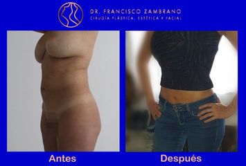 Dr. Francisco Zambrano - Liposuccion, lipectomia , lipoinyeccion glutea 