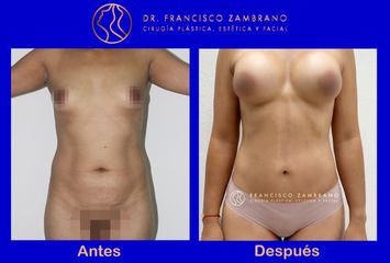 Dr. Francisco Zambrano - LIPECTOMIA CON MARCACION ABDOMINAL