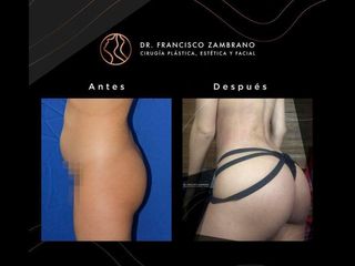 Gluteoplastia - Dr. Francisco Zambrano
