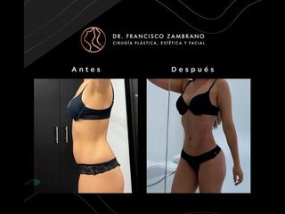Liposucción - Dr. Francisco Zambrano