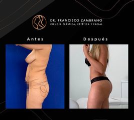 Lipoescultura - Dr. Francisco Zambrano