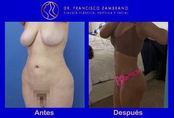 Liposucción - Dr. Francisco Zambrano