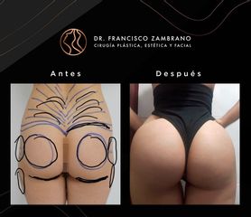 Gluteoplastia - Dr. Francisco Zambrano