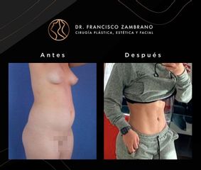 Liposucción - Dr. Francisco Zambrano