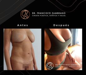 Lipoescultura - Dr. Francisco Zambrano