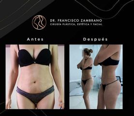 Liposucción - Dr. Francisco Zambrano