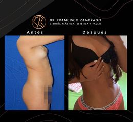 Lipoescultura - Dr. Francisco Zambrano