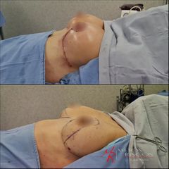 Levantamiento de senos - Dr. Milton Rincón Carranza