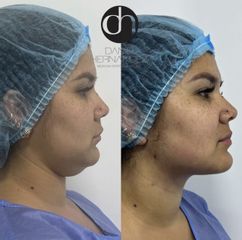 Cirugía de papada - Dr. Daniel Hernández