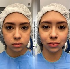 Aumento de labios - Dr. Daniel Hernández