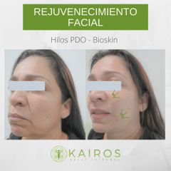Rejuvenecimiento facial - Kairos Salud Integral