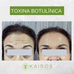 Toxina Botulínica  - Kairos Salud Integral