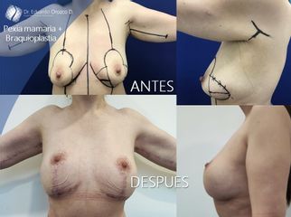 Levantamiento de senos - Dr. Eduardo Orozco Díaz
