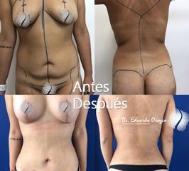 Lipoescultura - Dr. Eduardo Orozco Díaz
