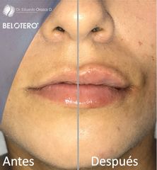 Aumento de labios - Dr. Eduardo Orozco Díaz