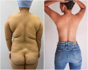 Liposucción - Dr. Jose Alfredo Burgos