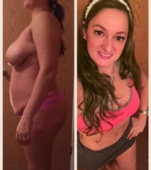 Abdominoplastia - Dr. Jose Alfredo Burgos