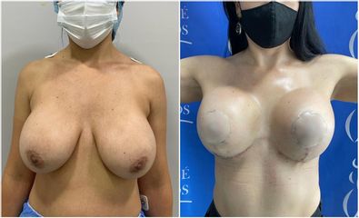 Mamoplastia de reducción - Dr. Jose Alfredo Burgos