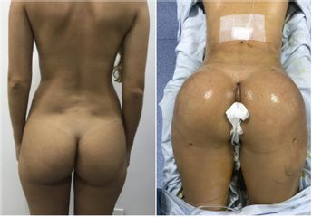 Gluteoplastia - Dr. Jose Alfredo Burgos