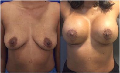 Mamoplastia de aumento - Dr. Jose Alfredo Burgos