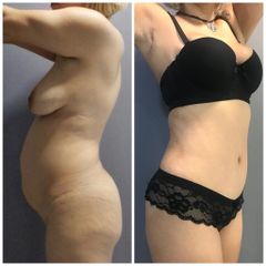 Abdominoplastia - Dr. Jose Alfredo Burgos