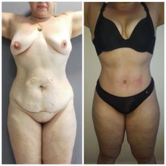 Abdominoplastia - Dr. Jose Alfredo Burgos