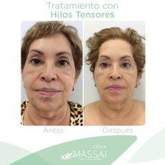Hilos tensores - Massai Clínica
