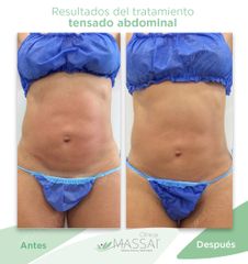 Mesoterapia - Massai Clínica
