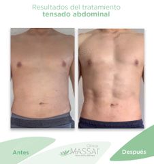 Tensado Abdominal - Massai Clínica