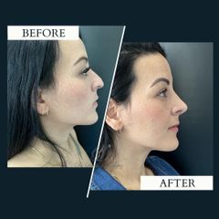 Rinoplastia - Dr. Darío Jurís