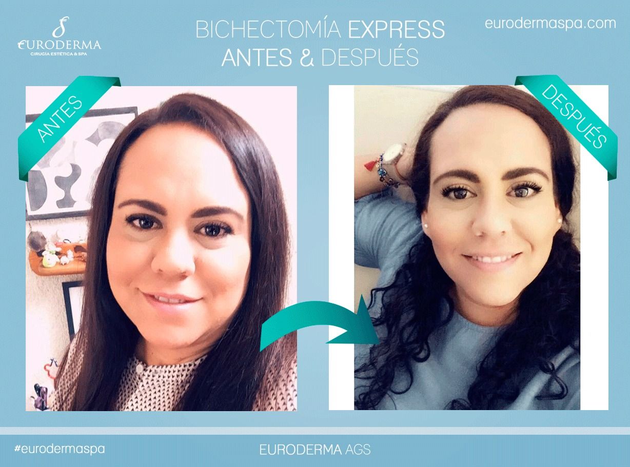 Antes y después de una bichectomía express