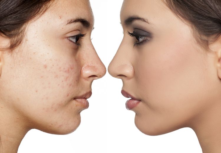 rostro de mujer antes y después de un tratamiento para las manchas