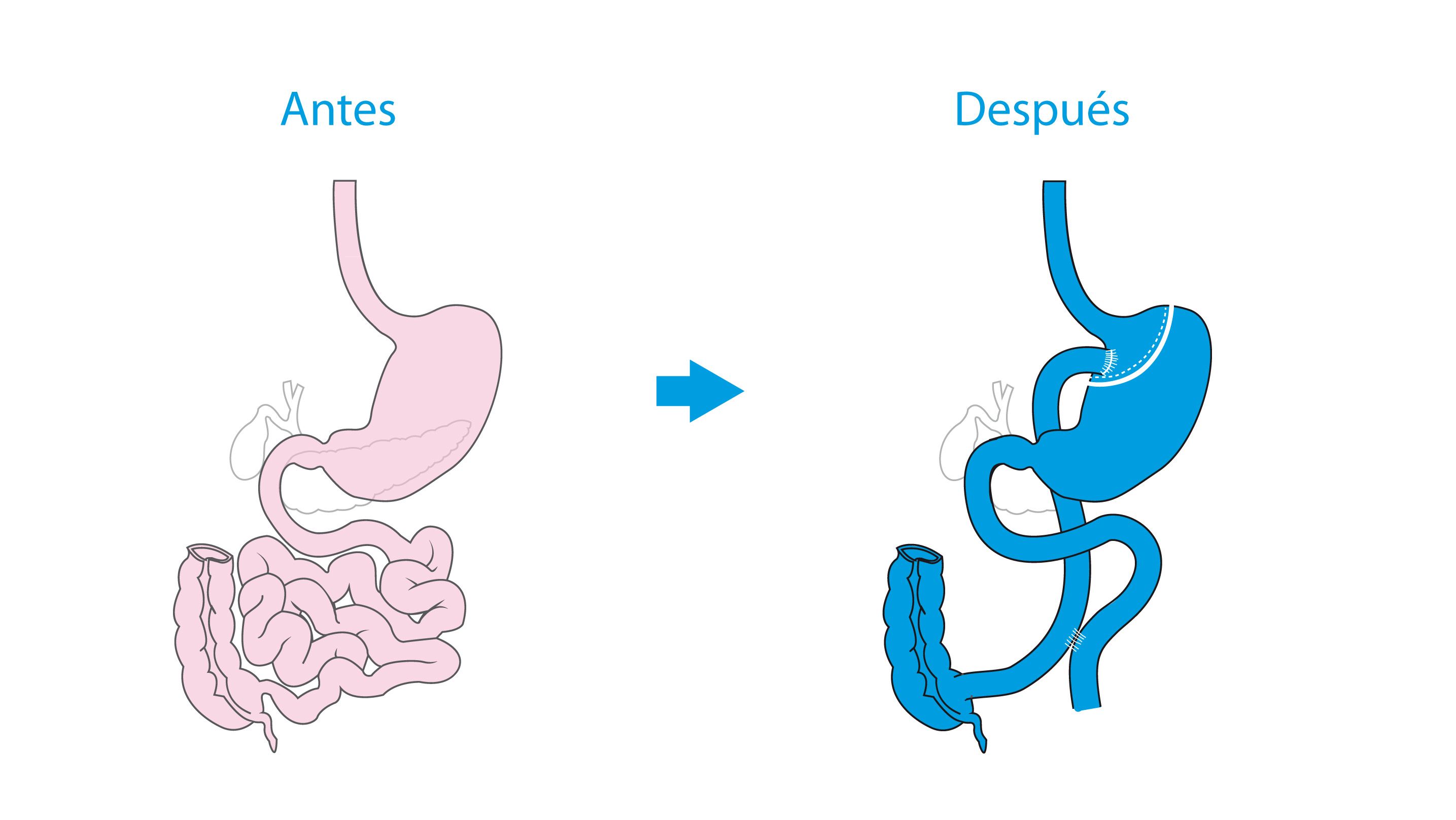 dibujo de dos estómagos, antes y después de un bypass gástrico