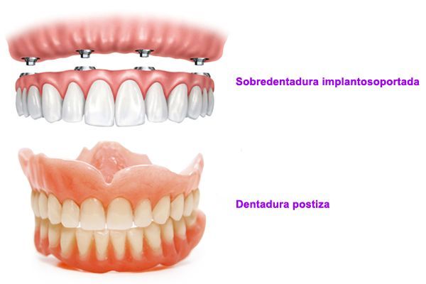 tipos de dentadura