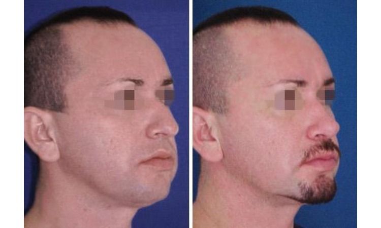 rinoplastia y cirugía de nariz