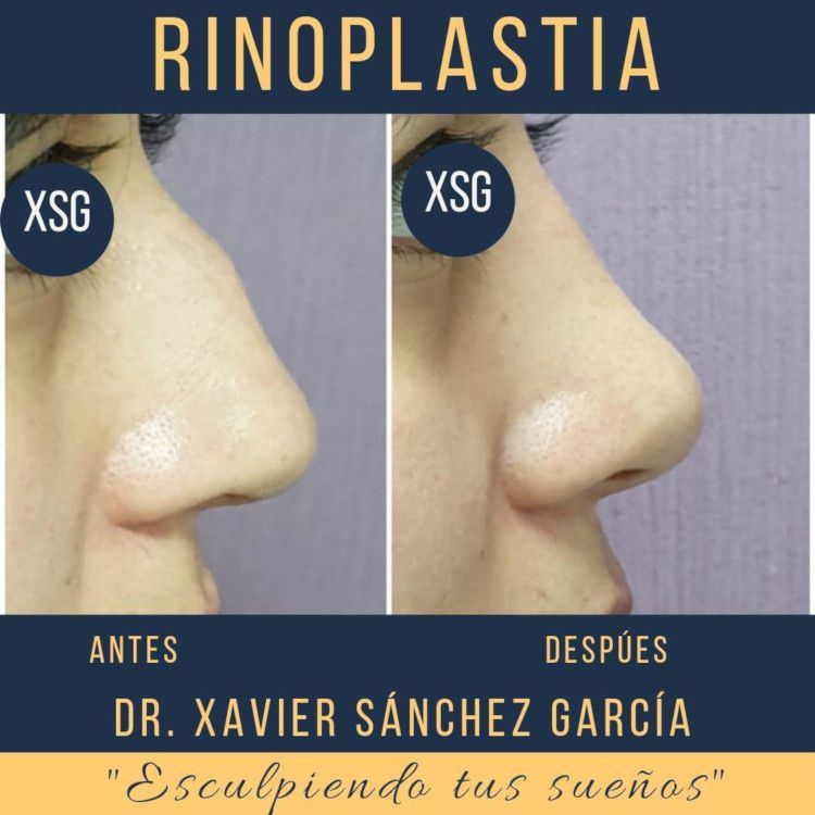 Antes y después de mujer con rinoplastia