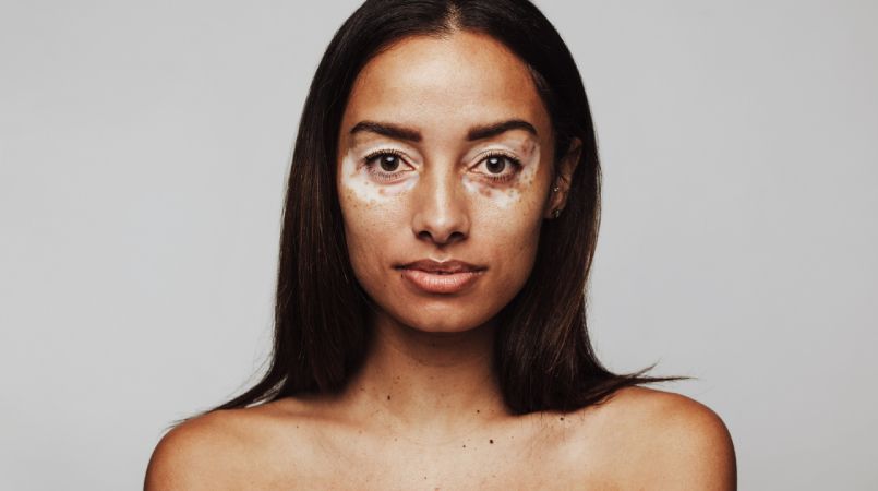 vitiligo en rostro