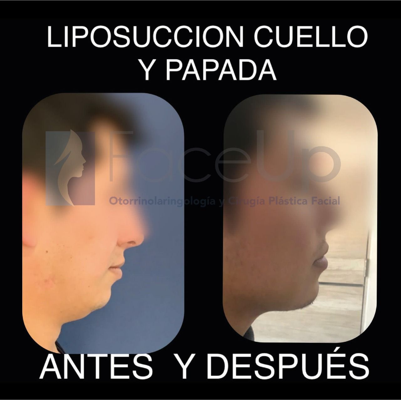 antes y después lipopapada