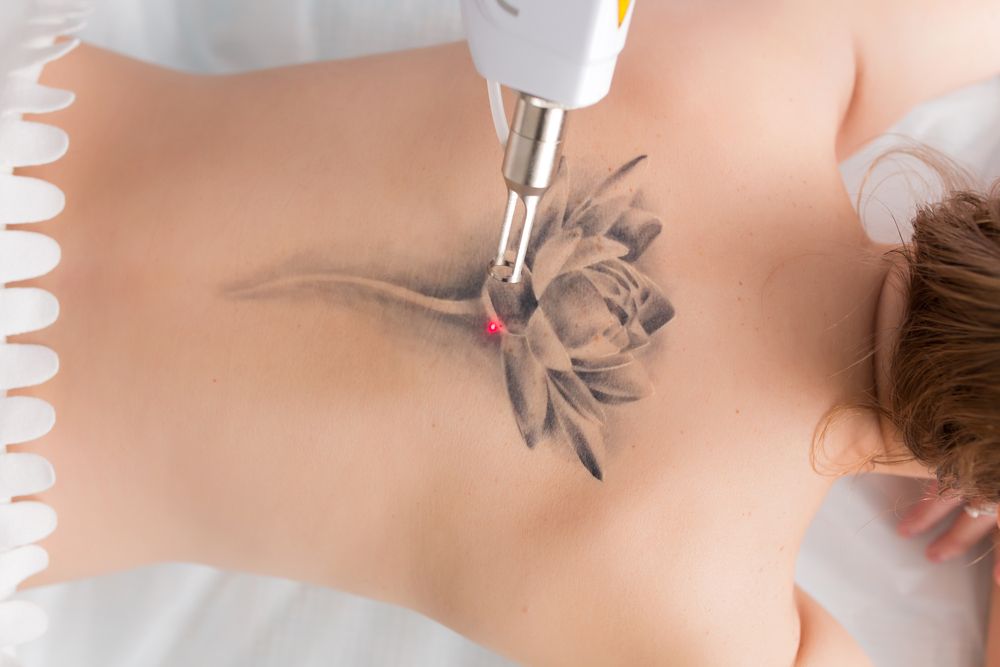 Eliminación de tatuaje con láser