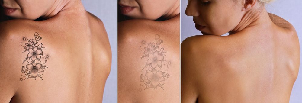mujer de espalda, antes y después de eliminar un tatuaje