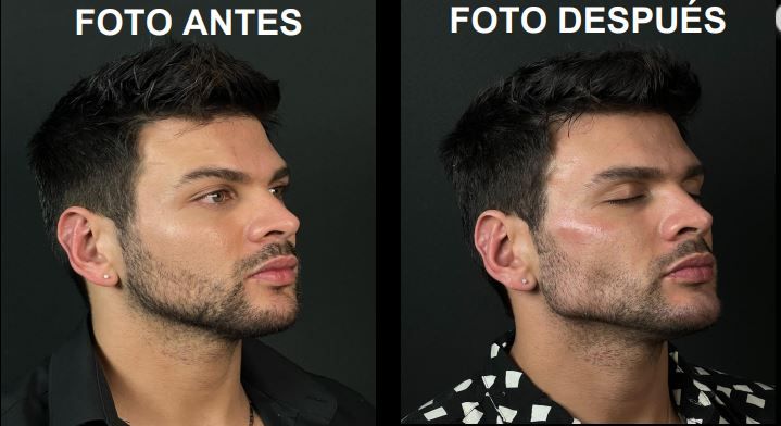 Antes y después de marcaje mandibular