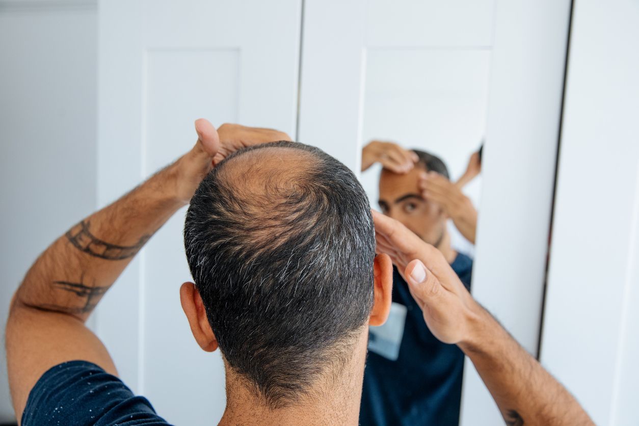 La pérdida de cabello tiene muchas causas