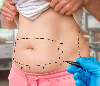 ¿Qué es la abdominoplastia?