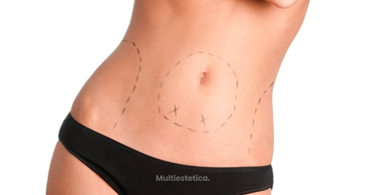 Liposuccion, el procedimiento y su tecnología.