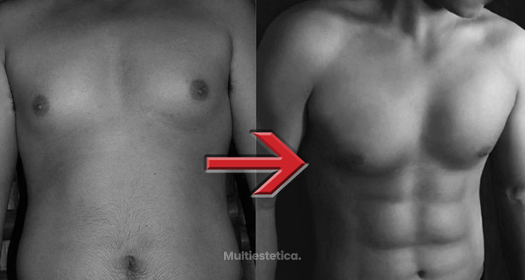 Liposucción de Alta Definición Hi-Def 4D